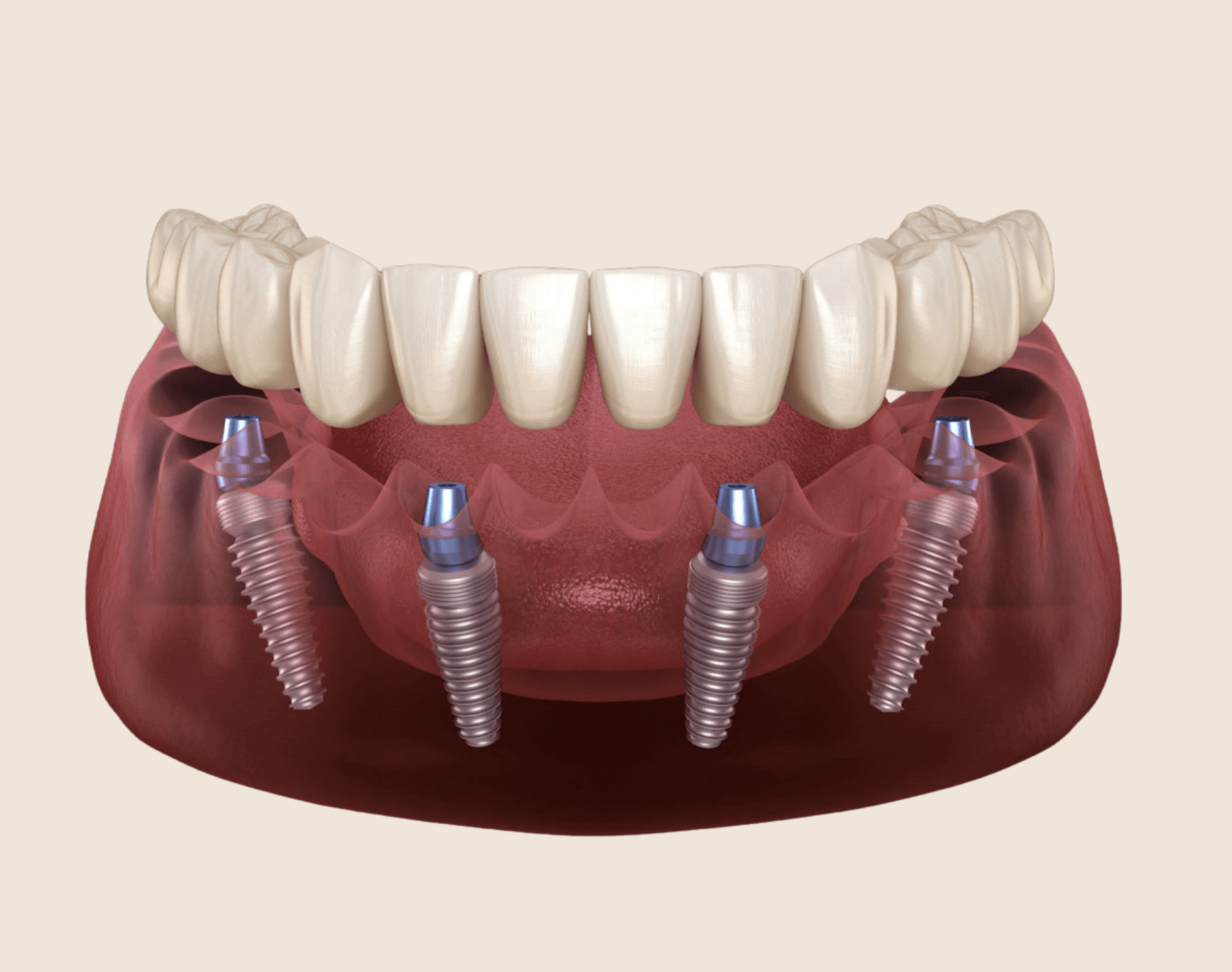 All-on-4 Dental Implants treatment at Smiles4Life Dental & Braces, Thousand Oaks