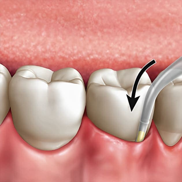 Arestin treatment at Smiles4Life Dental & Braces, Thousand Oaks
