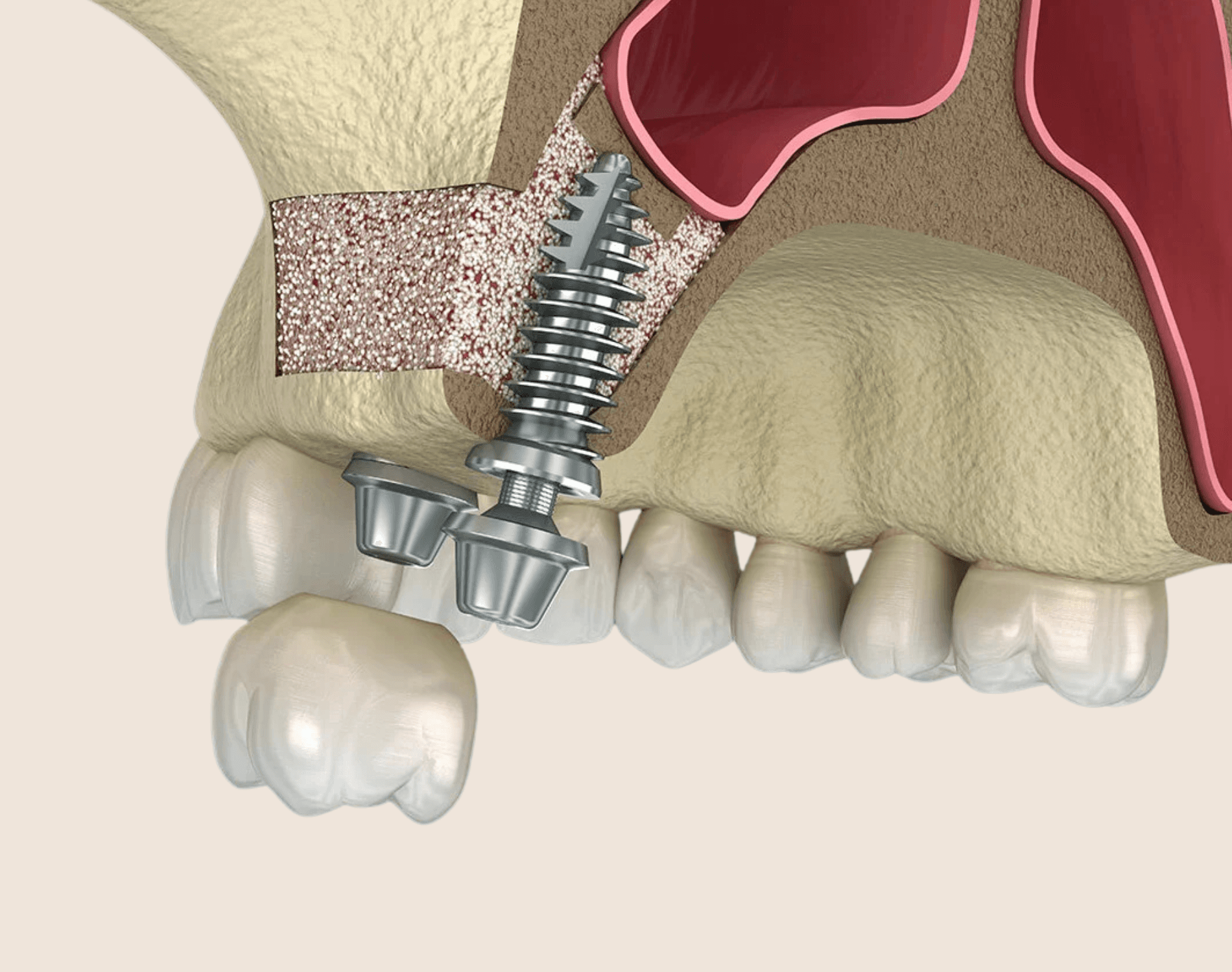 Bone Grafting treatment at Smiles4Life Dental & Braces, Thousand Oaks