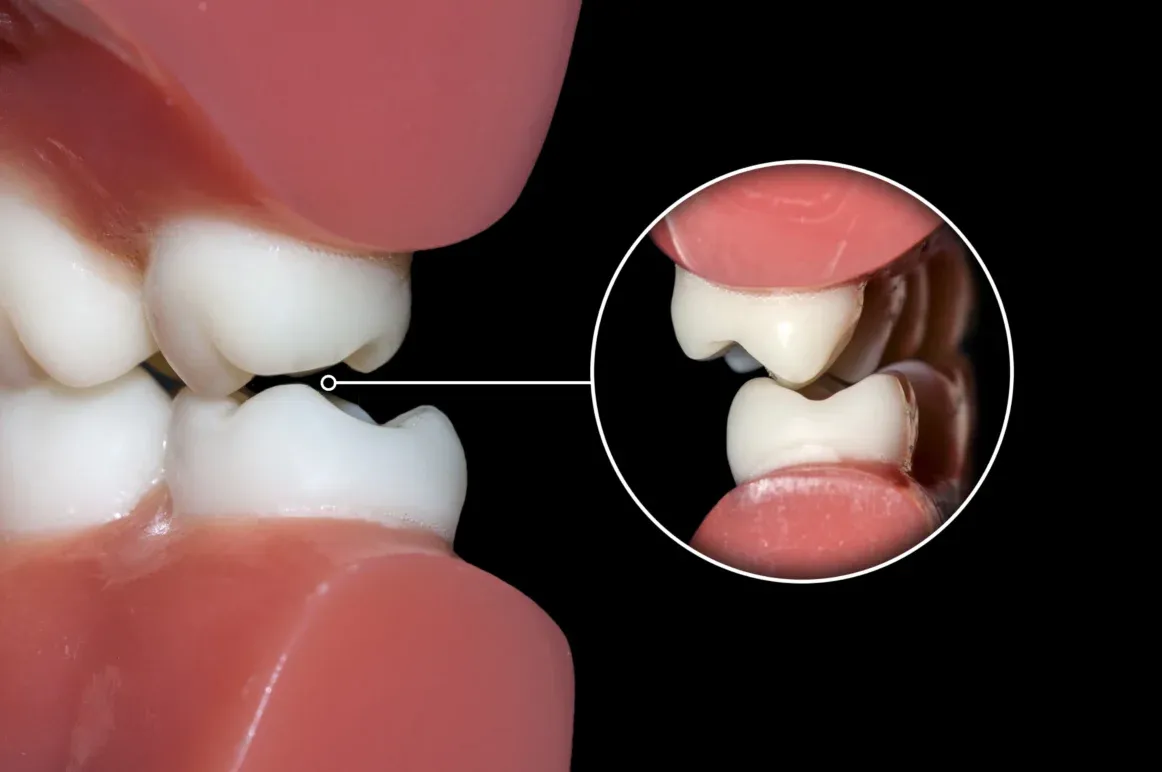 Bruxism (Teeth Grinding) Treatment treatment at Smiles4Life Dental & Braces, Thousand Oaks