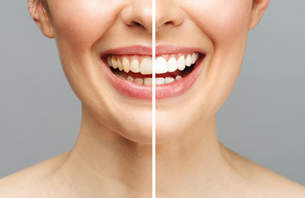 Cosmetic Gum Contouring treatment at Smiles4Life Dental & Braces, Thousand Oaks