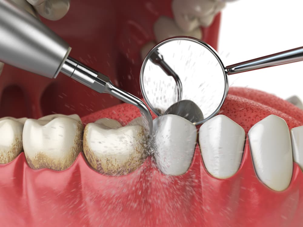 Deep Cleaning treatment at Smiles4Life Dental & Braces, Thousand Oaks