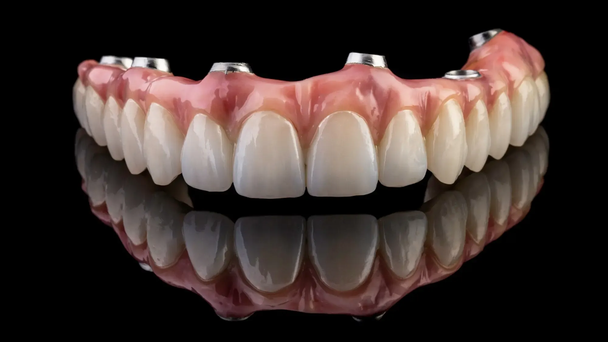 Full Arch Dental Implants treatment at Smiles4Life Dental & Braces, Thousand Oaks
