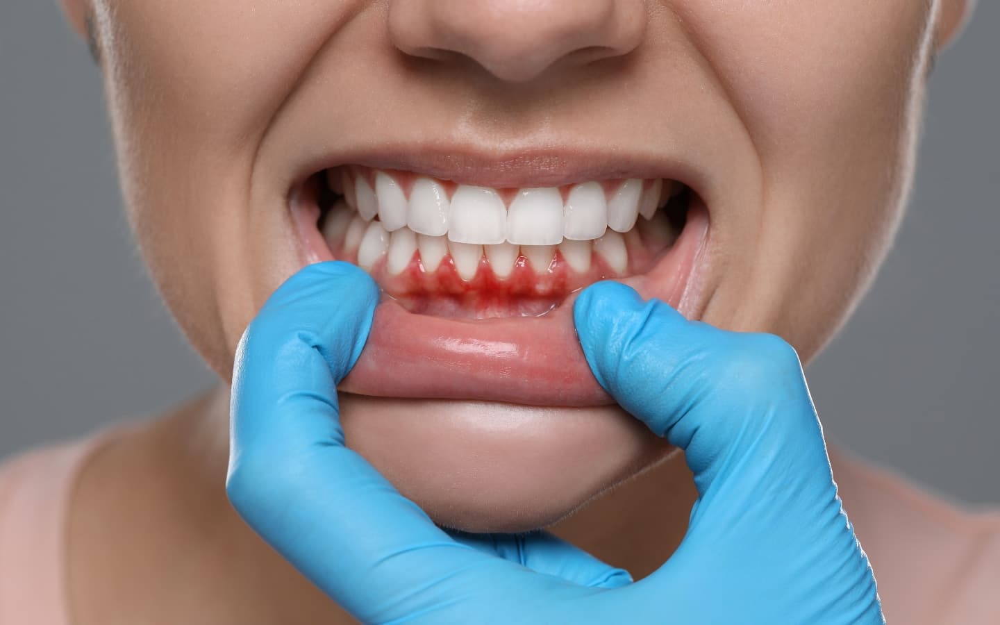 Gum Disease Treatment treatment at Smiles4Life Dental & Braces, Thousand Oaks