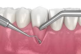Gum Grafting treatment at Smiles4Life Dental & Braces, Thousand Oaks