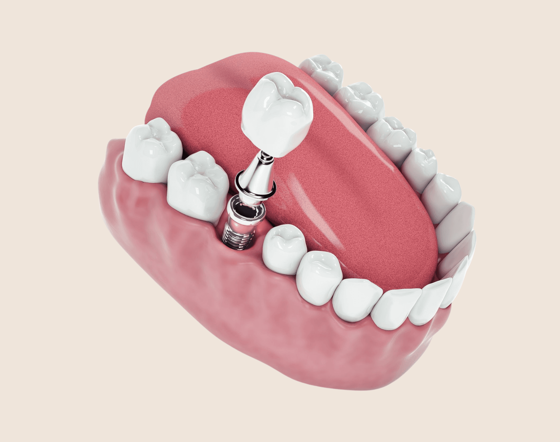 Implant Specialist treatment at Smiles4Life Dental & Braces, Thousand Oaks