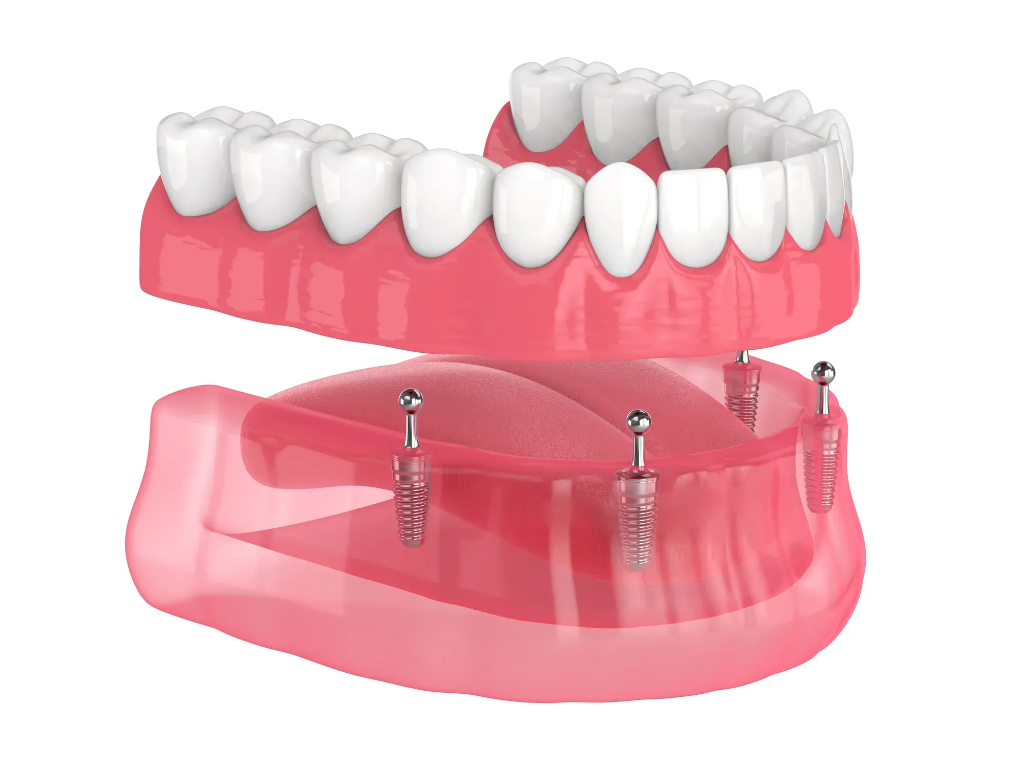 Implant-Supported Dentures treatment at Smiles4Life Dental & Braces, Thousand Oaks