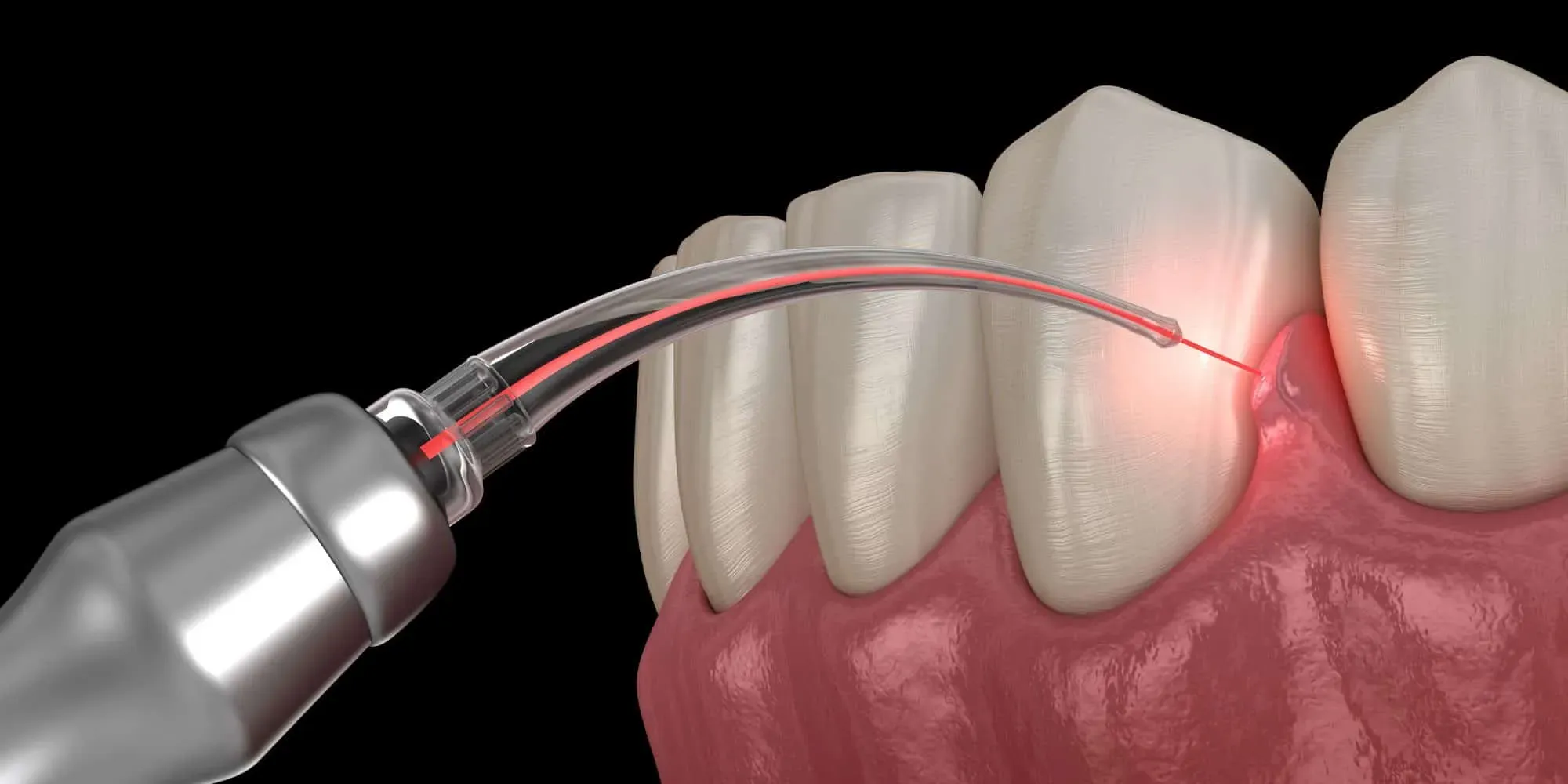 LANAP Procedure