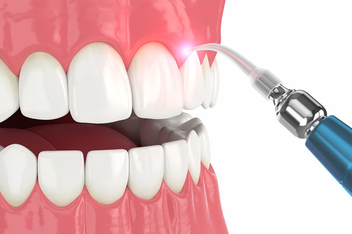 Laser Gum Therapy