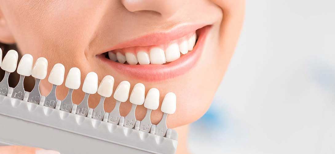 Lumineers treatment at Smiles4Life Dental & Braces, Thousand Oaks