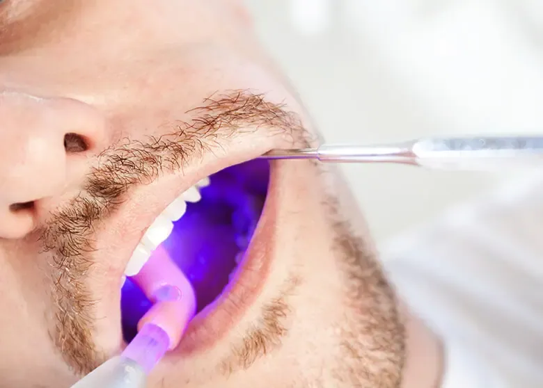 Oral Cancer Screening treatment at Smiles4Life Dental & Braces, Thousand Oaks