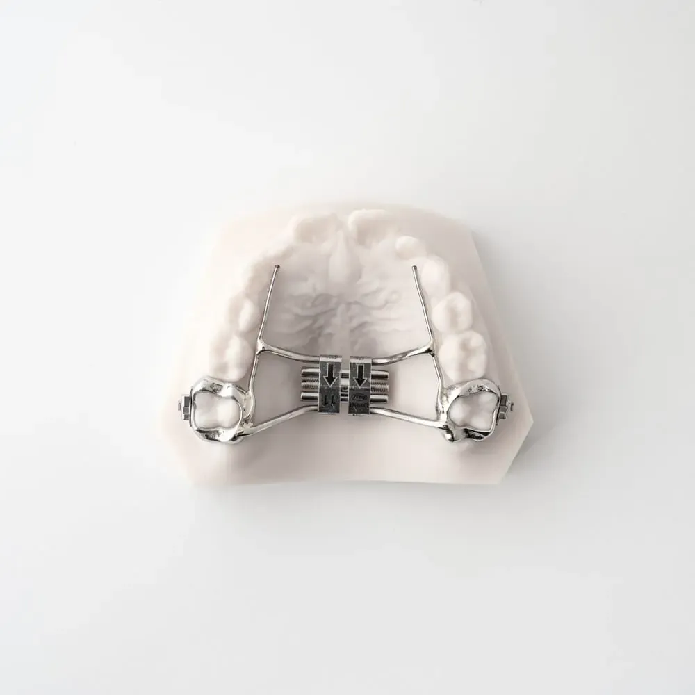 Palatal Expander treatment at Smiles4Life Dental & Braces, Thousand Oaks