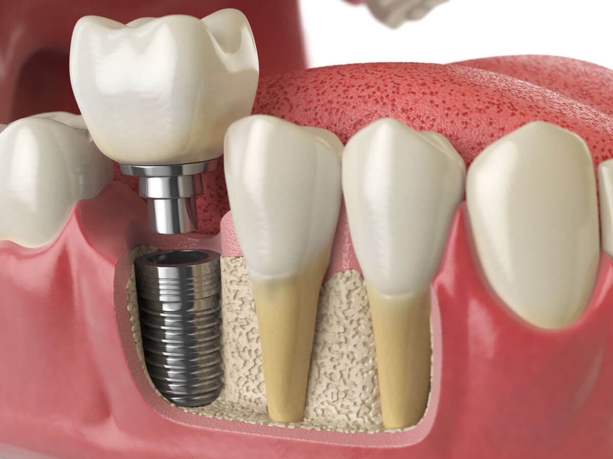 Permanent Tooth Replacement treatment at Smiles4Life Dental & Braces, Thousand Oaks