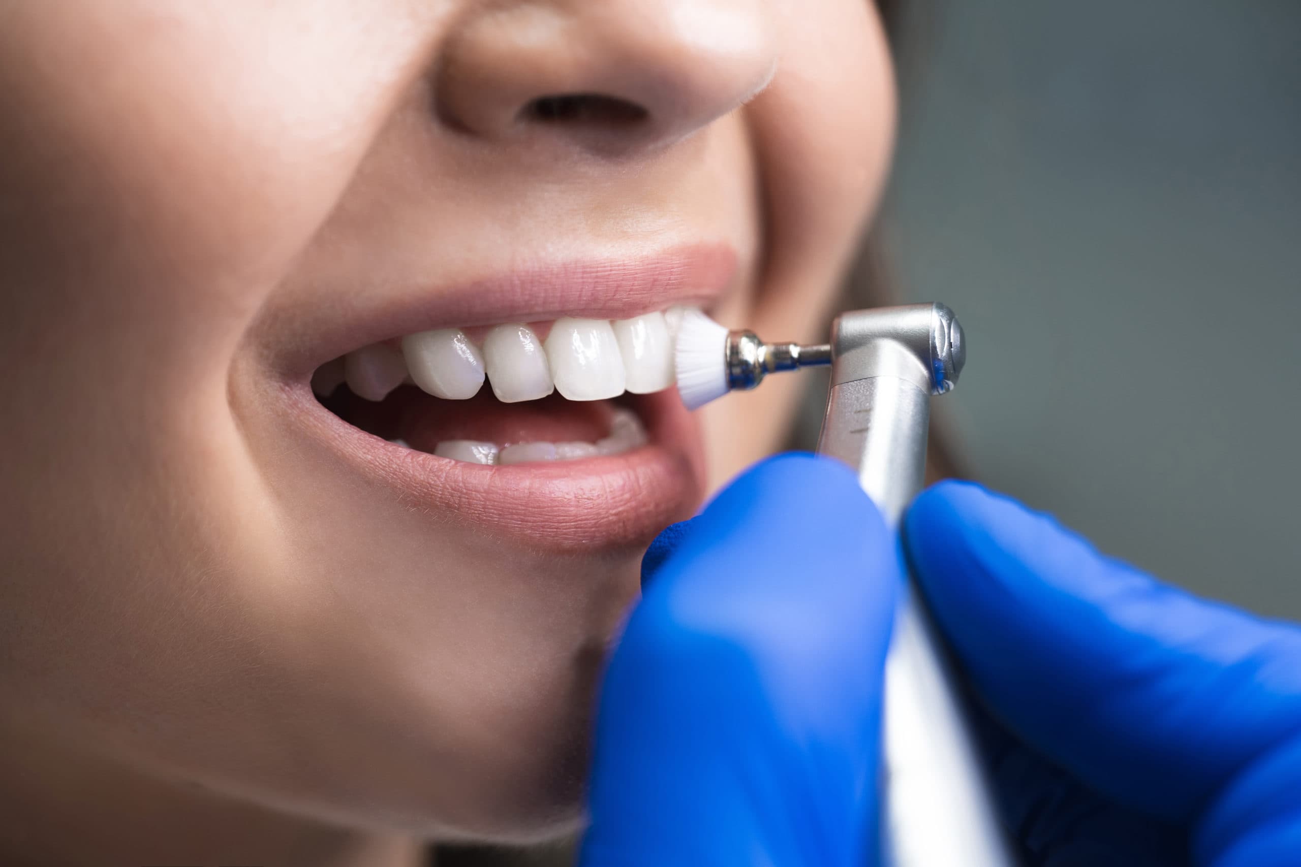Regular Teeth Cleaning treatment at Smiles4Life Dental & Braces, Thousand Oaks
