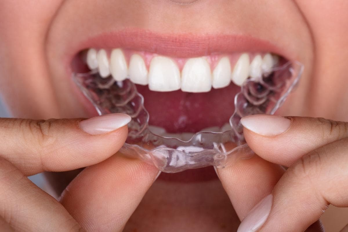 Retainers treatment at Smiles4Life Dental & Braces, Thousand Oaks