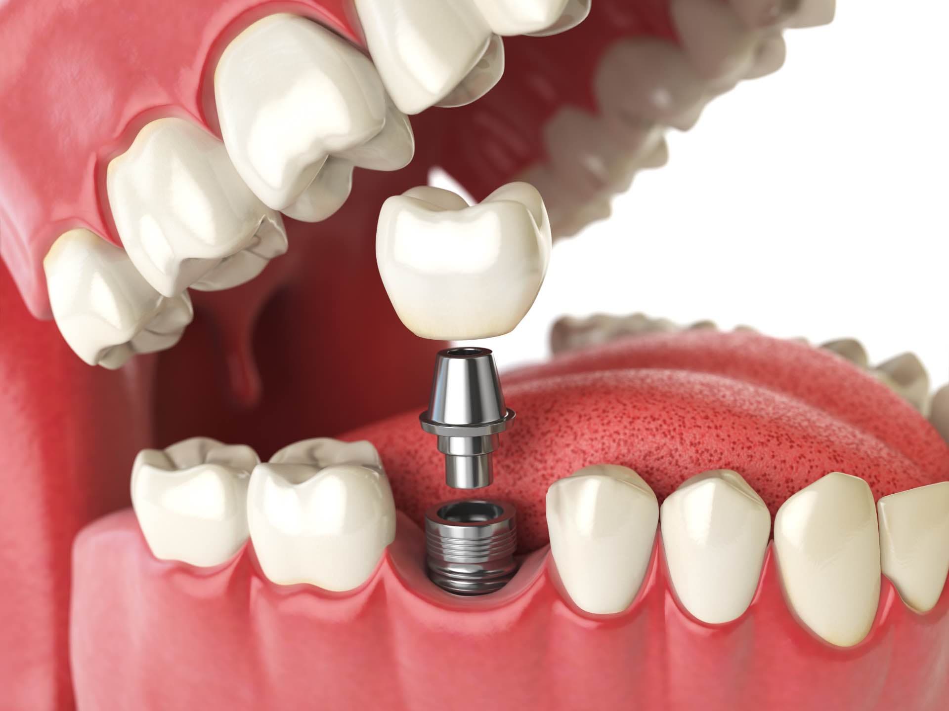 Same-Day Dental Implants treatment at Smiles4Life Dental & Braces, Thousand Oaks