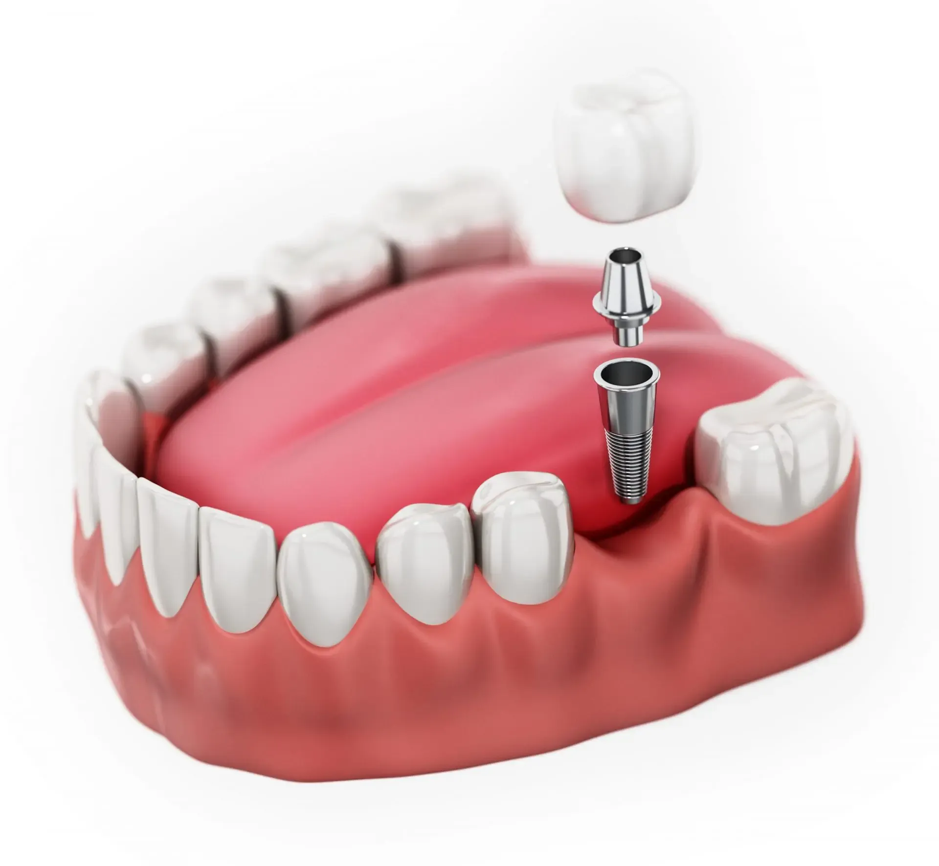 Single Tooth Implants treatment at Smiles4Life Dental & Braces, Thousand Oaks