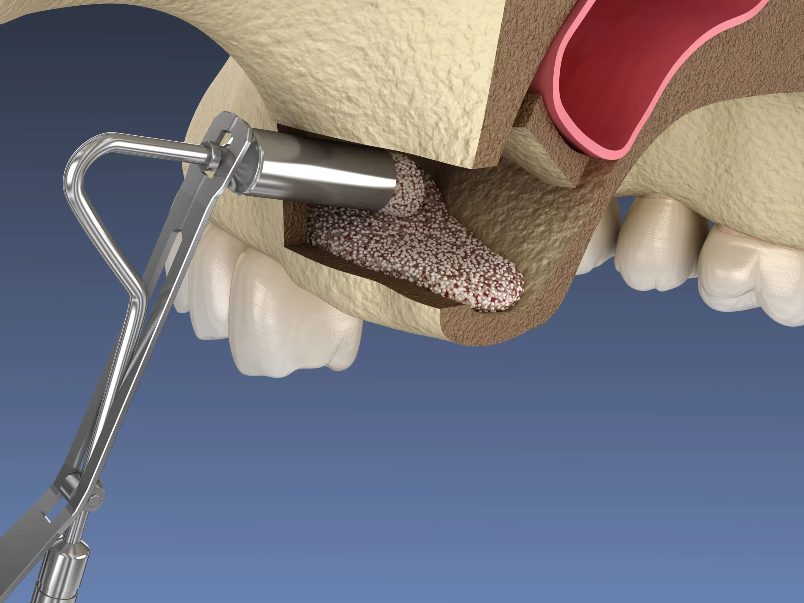 Sinus Lift Surgery treatment at Smiles4Life Dental & Braces, Thousand Oaks