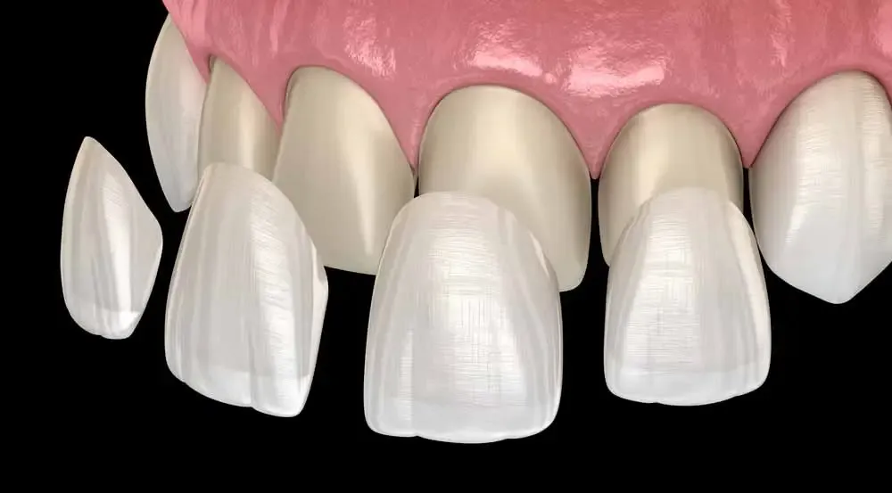 Veneers treatment at Smiles4Life Dental & Braces, Thousand Oaks